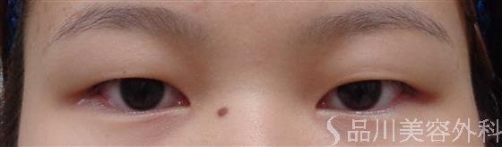 症例NO.60430のBEFORE写真