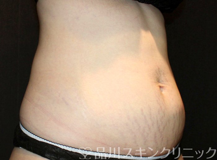 症例NO.72437のBEFORE写真