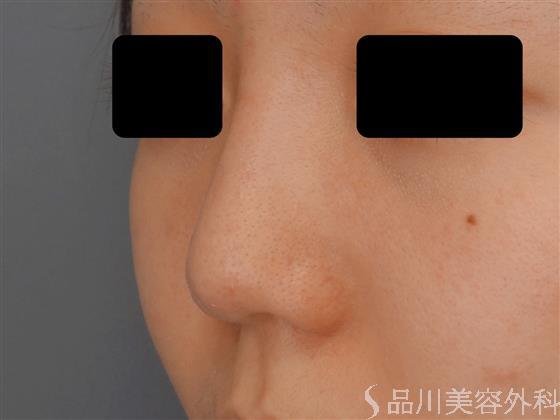 症例NO.60543のBEFORE写真