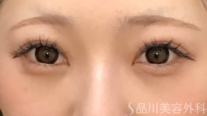 症例NO.65234のAFTER写真