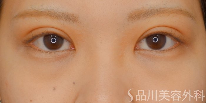 症例NO.73264のAFTER写真