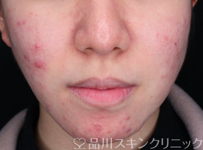 症例NO.74200のBEFORE写真