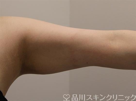 症例NO.49334のBEFORE写真