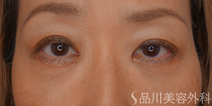 症例NO.74407のAFTER写真