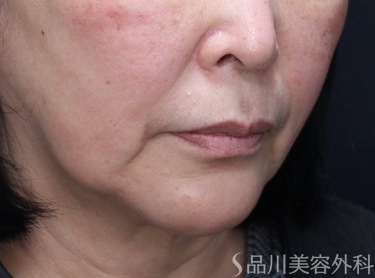 症例NO.72985のBEFORE写真