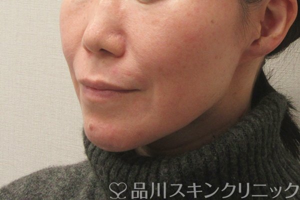 症例NO.75393のBEFORE写真