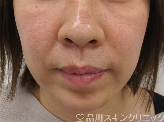 症例NO.58186のBEFORE写真