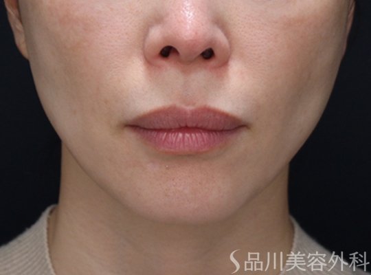 症例NO.73348のAFTER写真