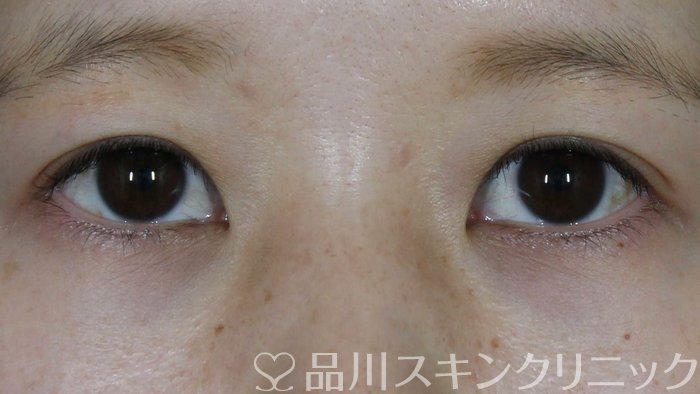 症例NO.71771のBEFORE写真