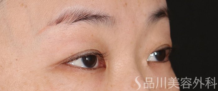 症例NO.72300のBEFORE写真