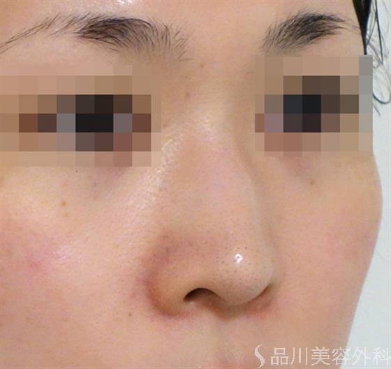 症例NO.37982のBEFORE写真