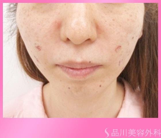 症例NO.14453のAFTER写真