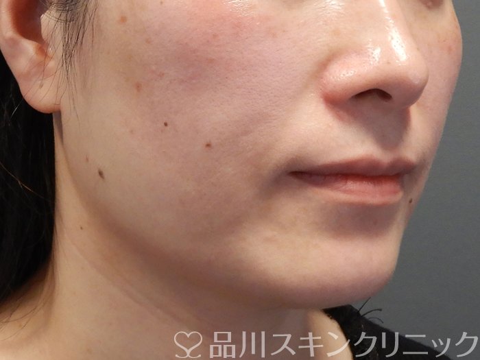 症例NO.69190のBEFORE写真