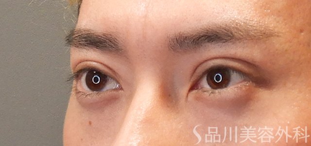 症例NO.72151のAFTER写真