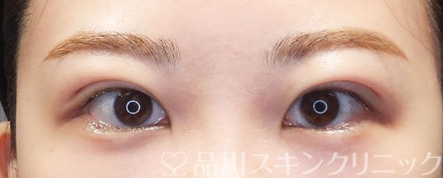 症例NO.75076のAFTER写真