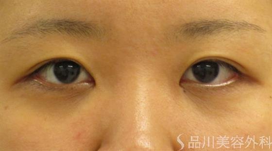 症例NO.44823のBEFORE写真