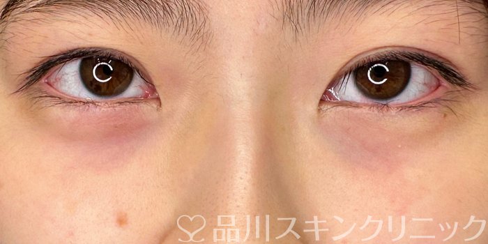 症例NO.62506のBEFORE写真