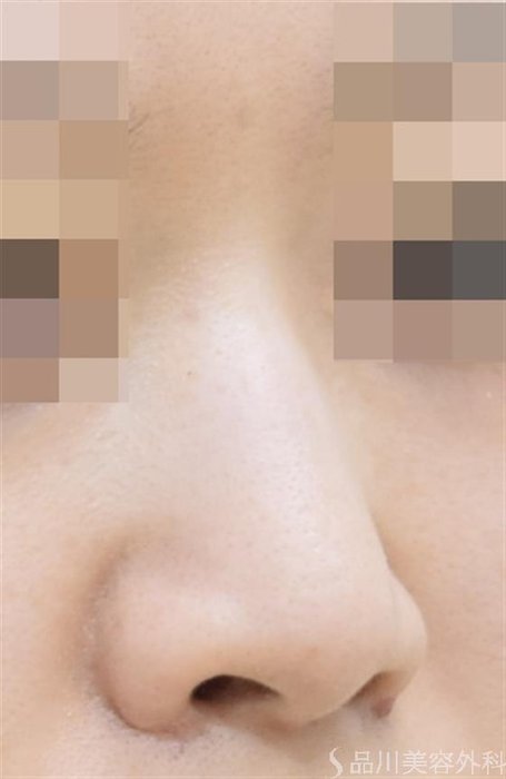 症例NO.42880のBEFORE写真