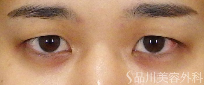 症例NO.71546のBEFORE写真