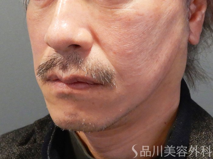 症例NO.70137のAFTER写真