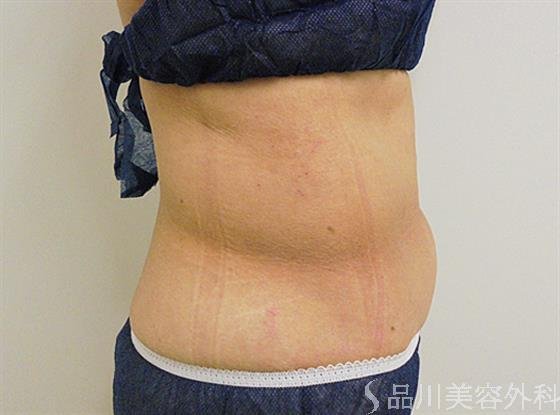 症例NO.22255のAFTER写真
