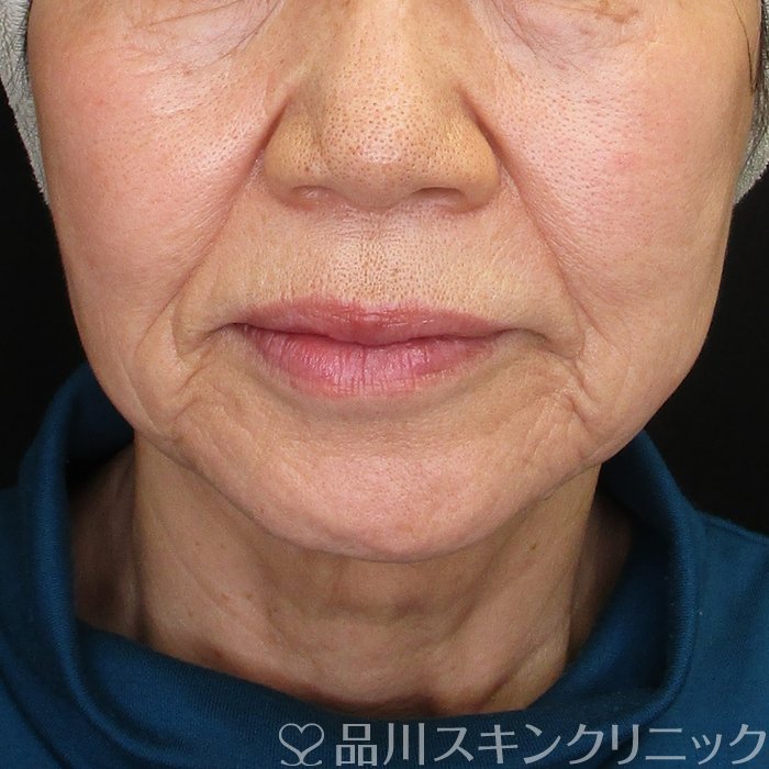 症例NO.73673のBEFORE写真