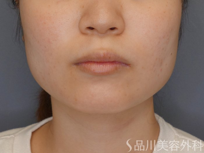 症例NO.70415のBEFORE写真