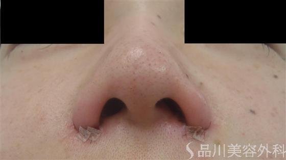 症例NO.13033のAFTER写真