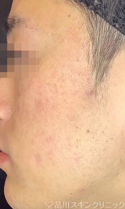症例NO.69608のAFTER写真