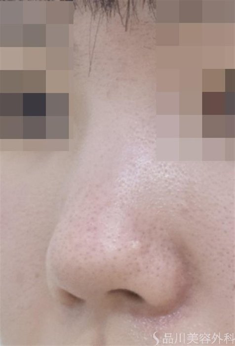 症例NO.52913のBEFORE写真