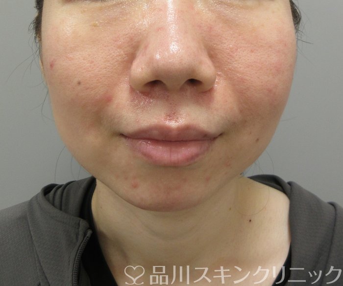 症例NO.73091のAFTER写真