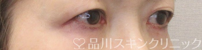 症例NO.70908のAFTER写真
