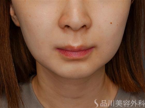 症例NO.59069のBEFORE写真