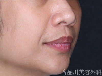 症例NO.74688のBEFORE写真