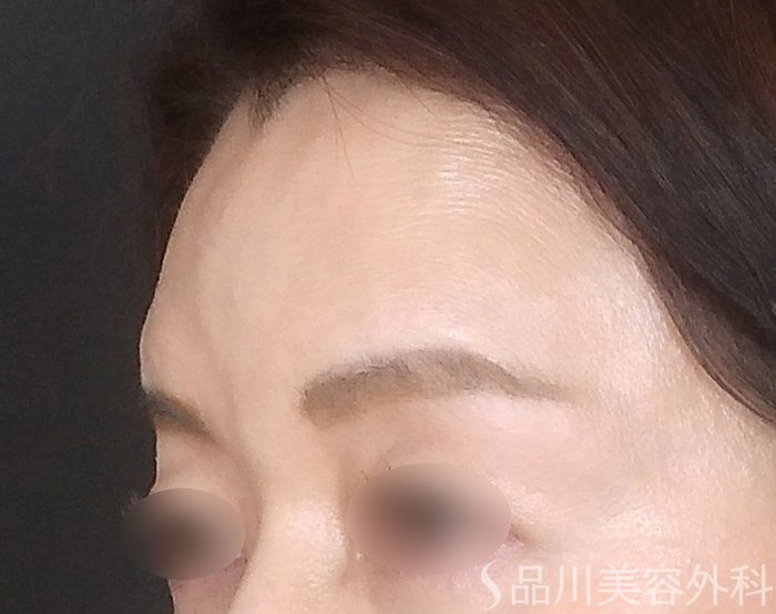 症例NO.67645のBEFORE写真