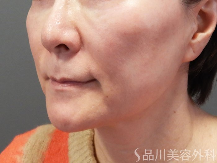 症例NO.73269のBEFORE写真