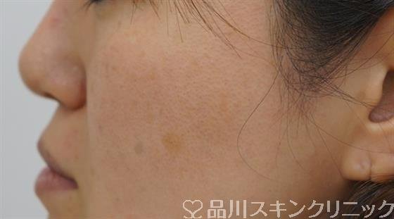 症例NO.39661のBEFORE写真
