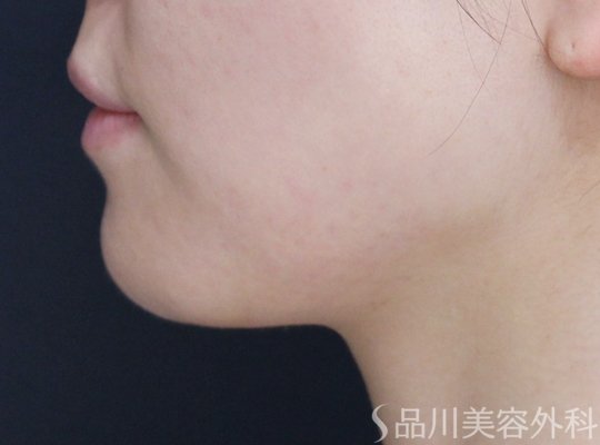 症例NO.71271のAFTER写真