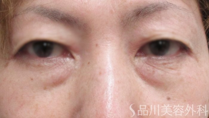 症例NO.63741のBEFORE写真