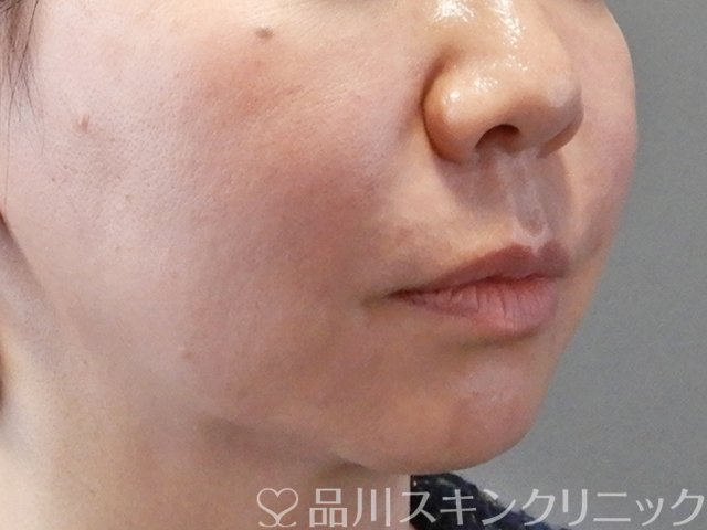 症例NO.63368のAFTER写真
