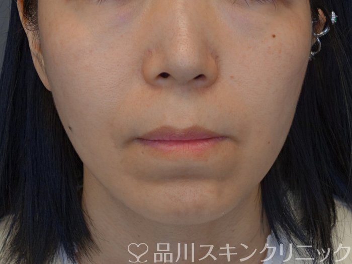 症例NO.73890のBEFORE写真