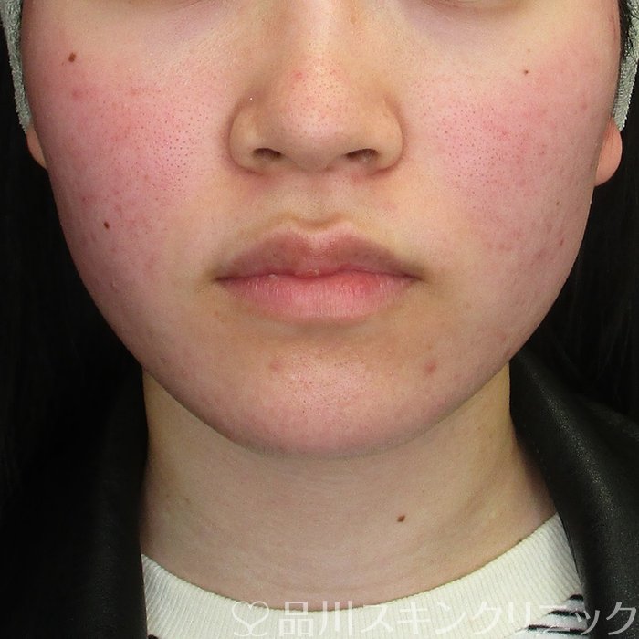 症例NO.73510のBEFORE写真