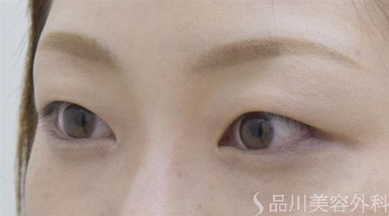 症例NO.53301のBEFORE写真