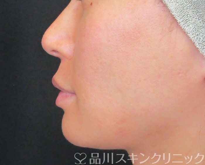 症例NO.72825のBEFORE写真