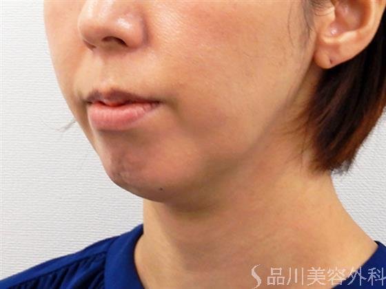 症例NO.52067のAFTER写真