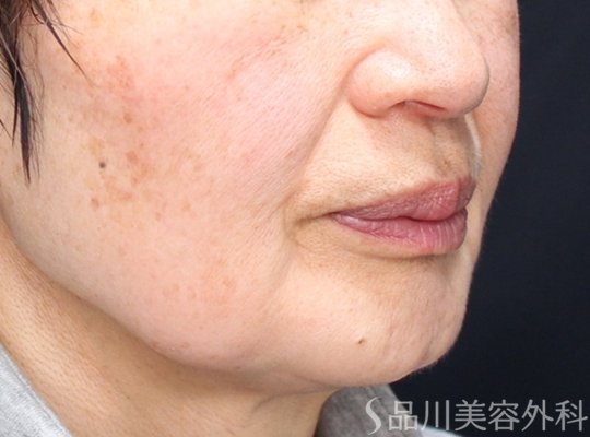 症例NO.74095のBEFORE写真
