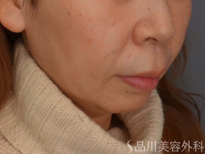 症例NO.65592のBEFORE写真