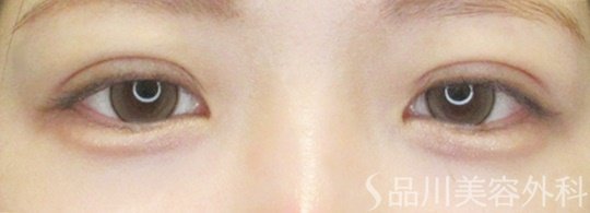 症例NO.69419のAFTER写真