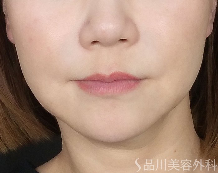 症例NO.65531のBEFORE写真