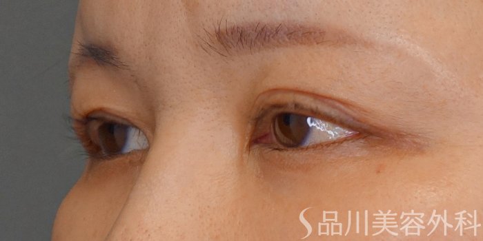 症例NO.72531のBEFORE写真